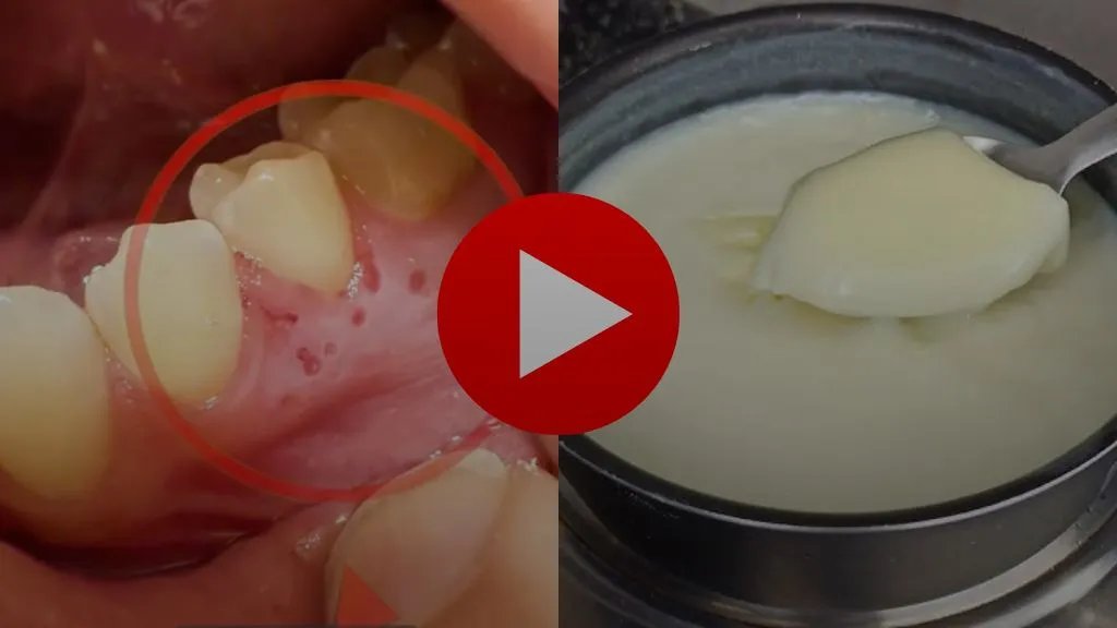 How to get rid of inflamed gums